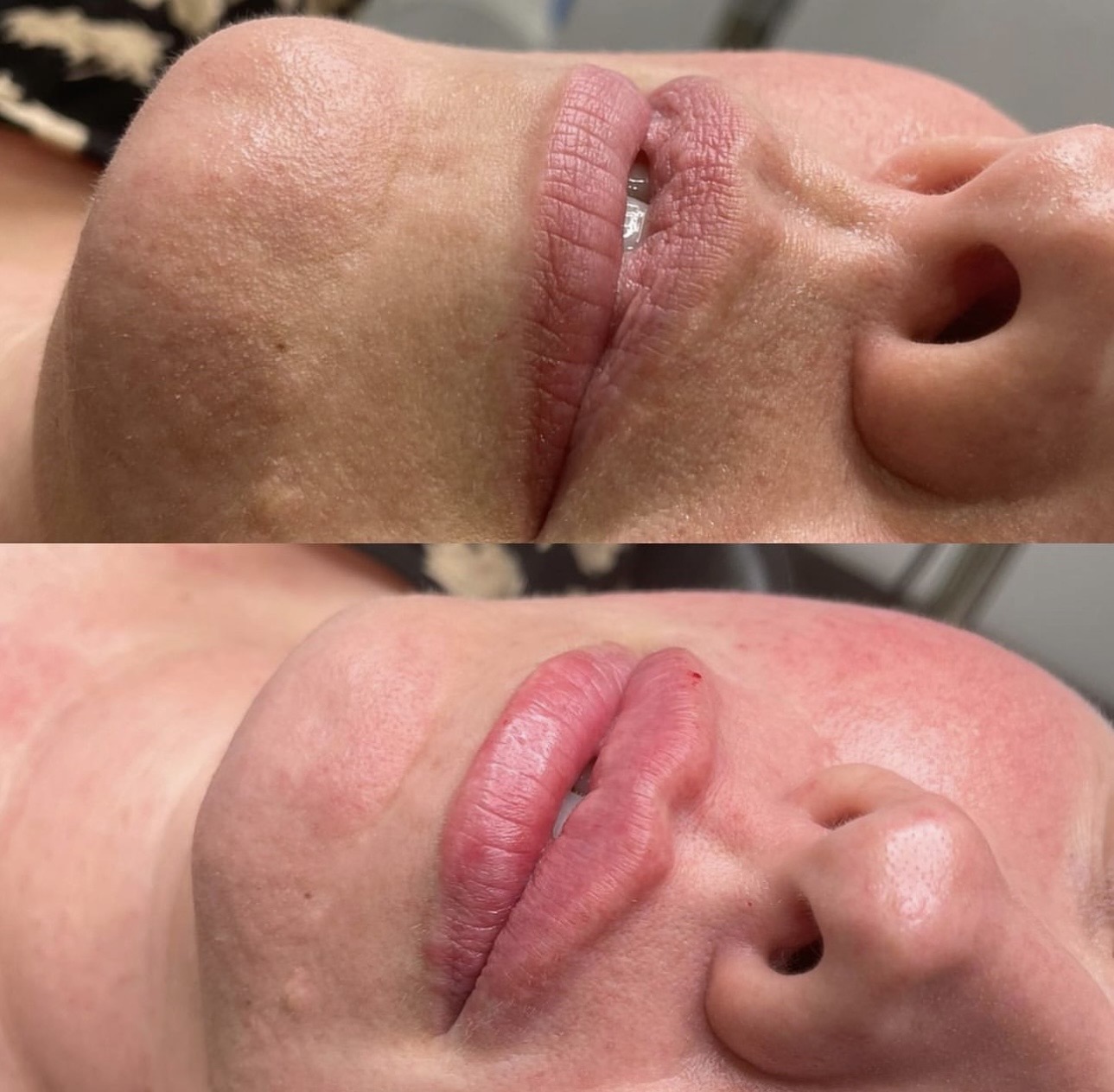 Russian Lip Filler by our practitioner Courtney 💉