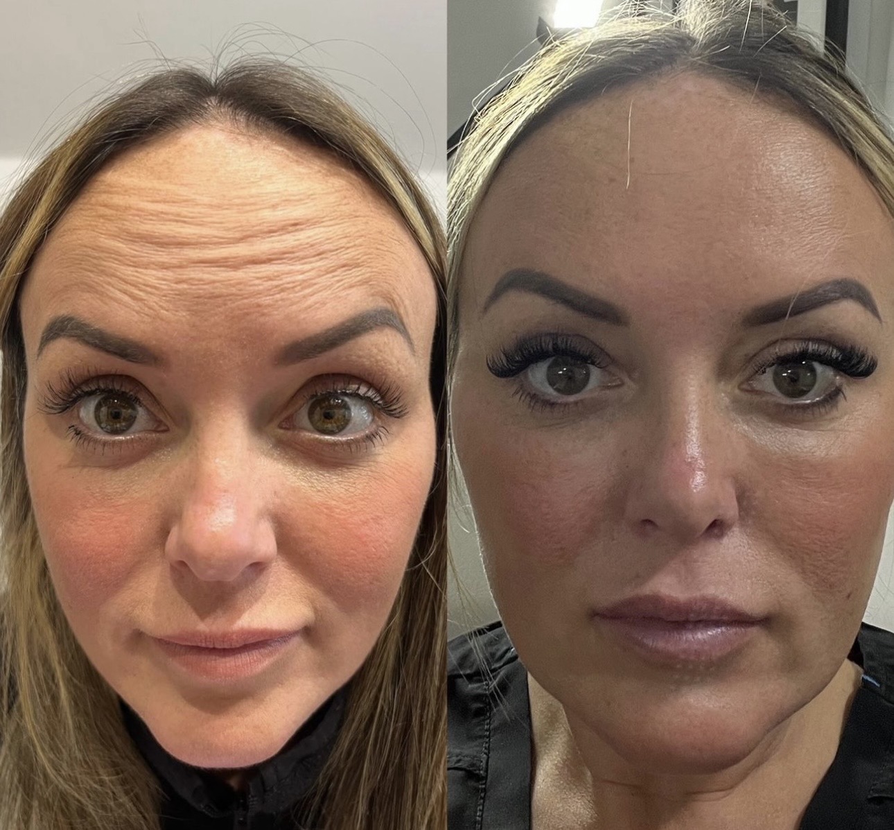 Anti-wrinkle treatment- One of Zoe’s FAVOURITE treatments!
