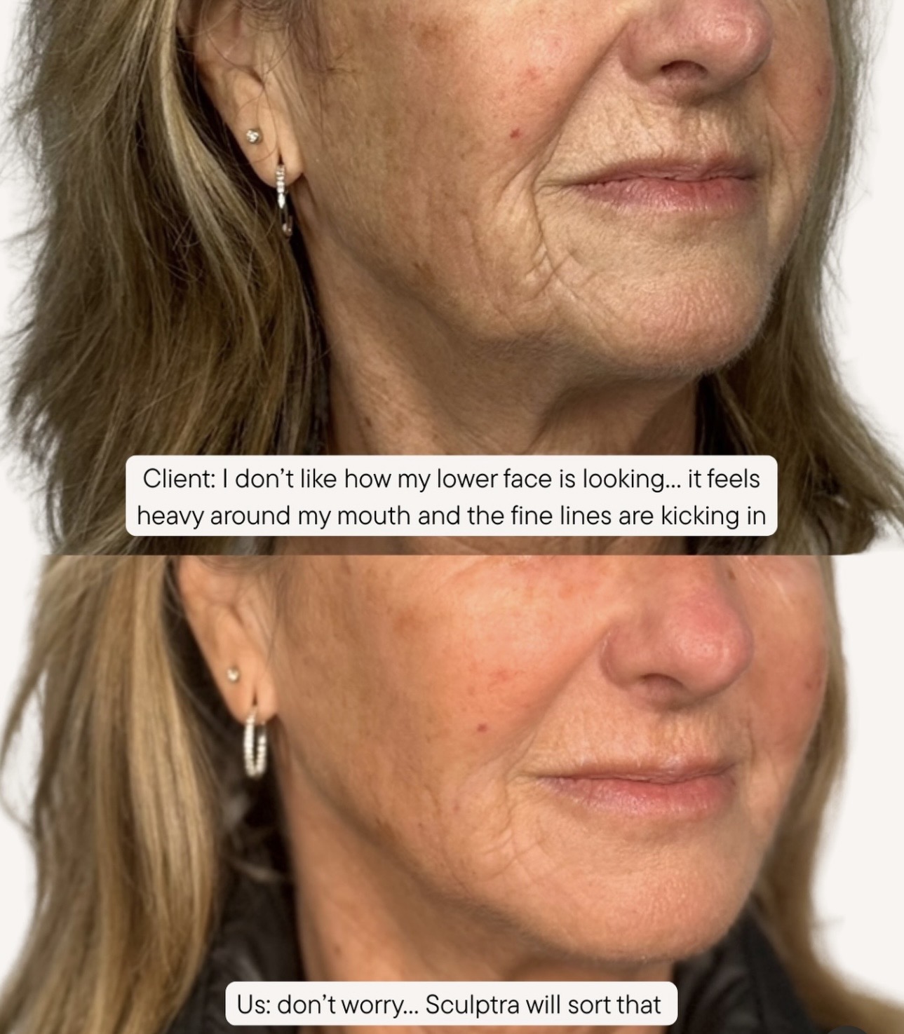 Jowl Transformation- Do you feel your lower face is sagging?