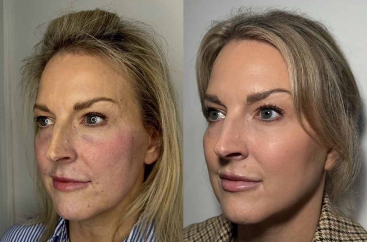 Client transformation- Sculptra, Cheek filler & anti-wrinkle treatment working their magic, and this is the result