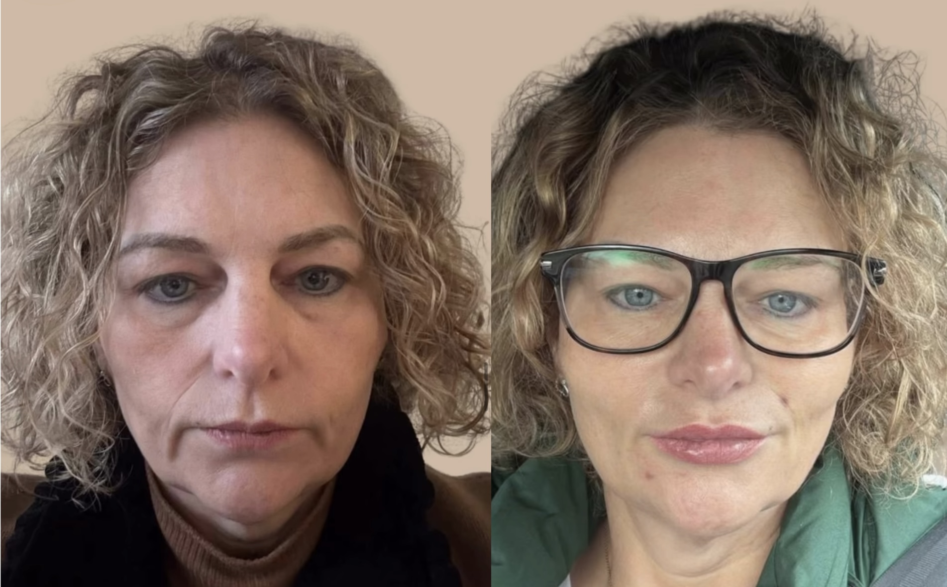 Sculptra, Marionette filler & anti-wrinkle treatment- Hayley is our gorgeous client who’s lost a significant amount of wei…