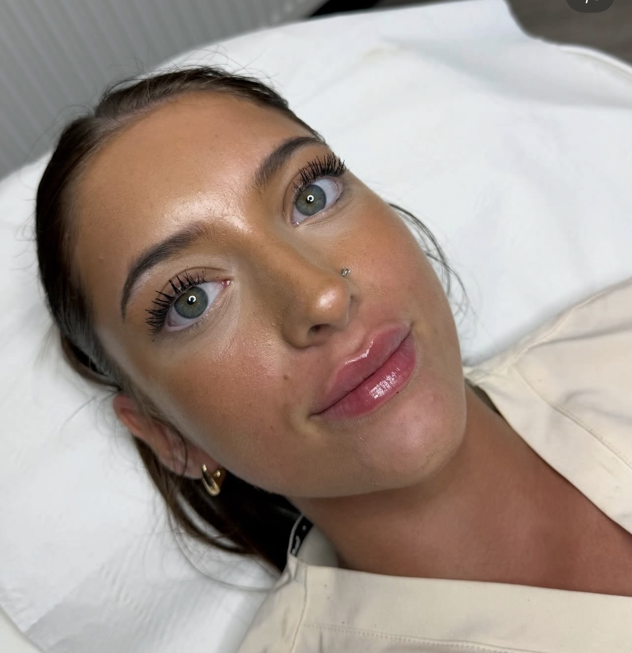 FIRST TIME LIP FILLER 🤍 A little enhancement.