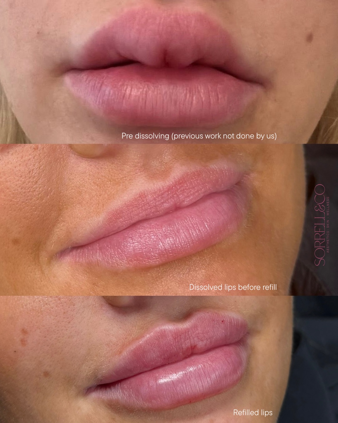 Sometimes the best thing we can do for your lips is tell you NOT to have more filler.