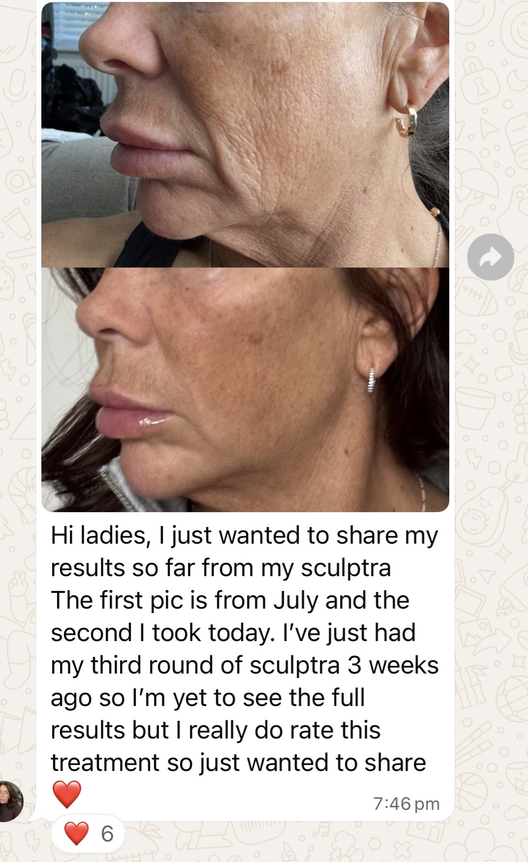 We talk good about Sculptra a lot, but we also bring the evidence to back our claims up.