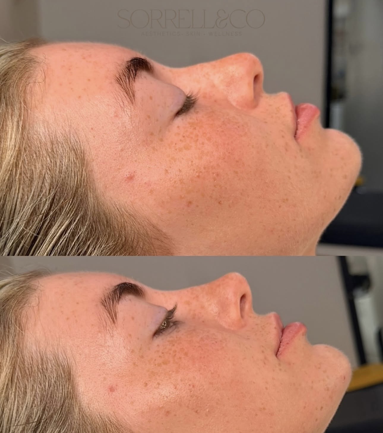 Non Surgical Rhinoplasty- Are you unhappy with your nose?