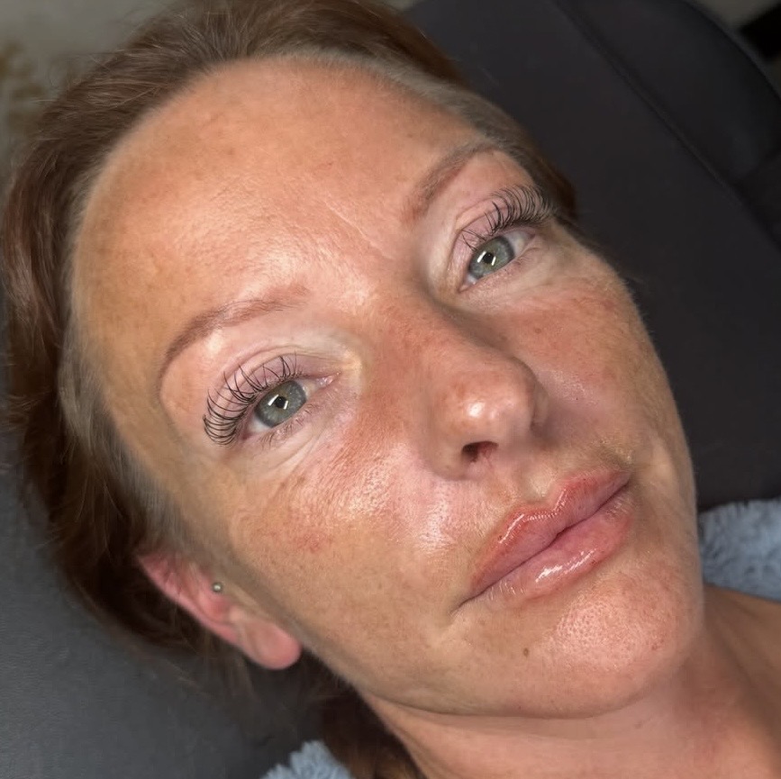 Jowls, lips & nasolabial lines ✨ A little enhancement in the right places can make such a difference.