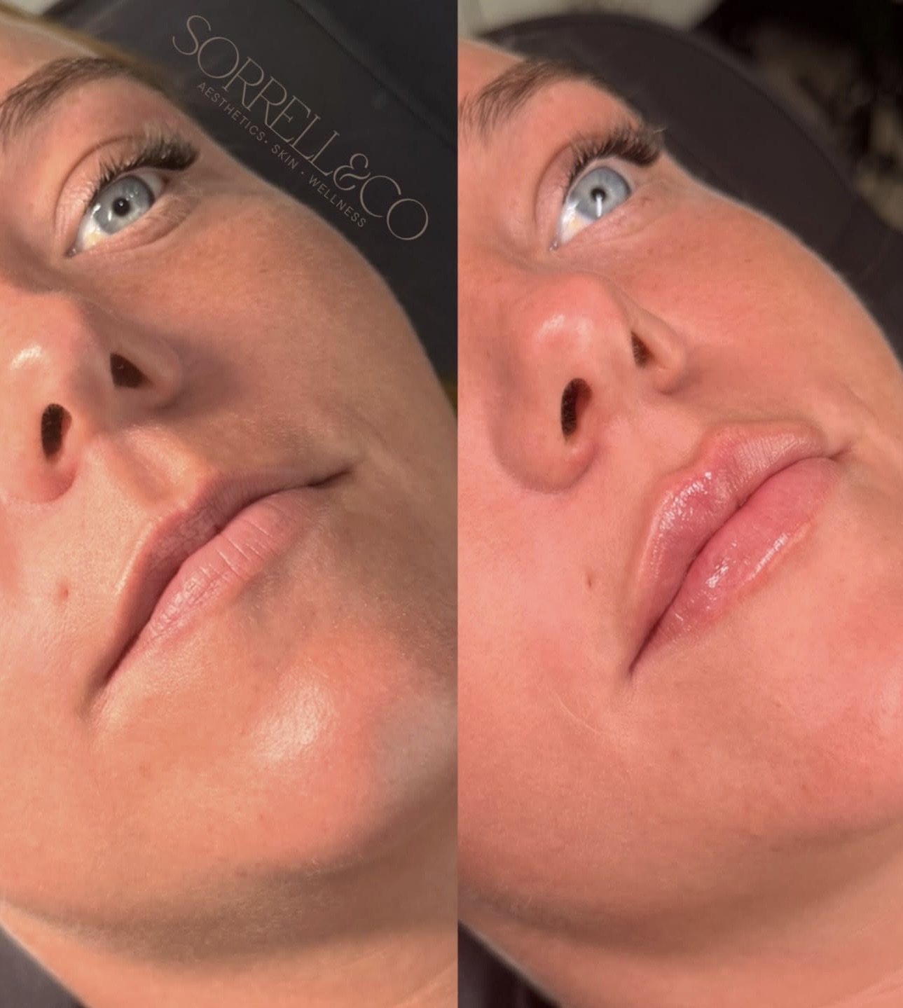 Lip Filler!