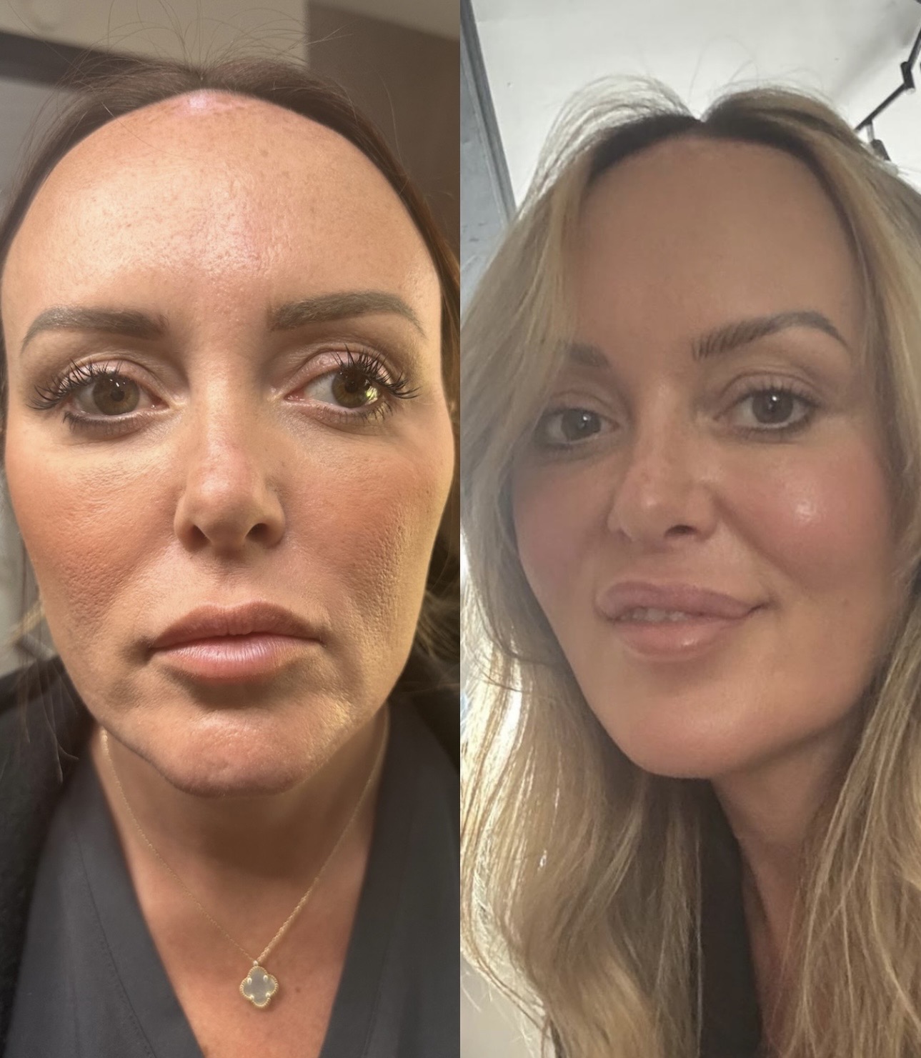 Sculptra is worth the with!