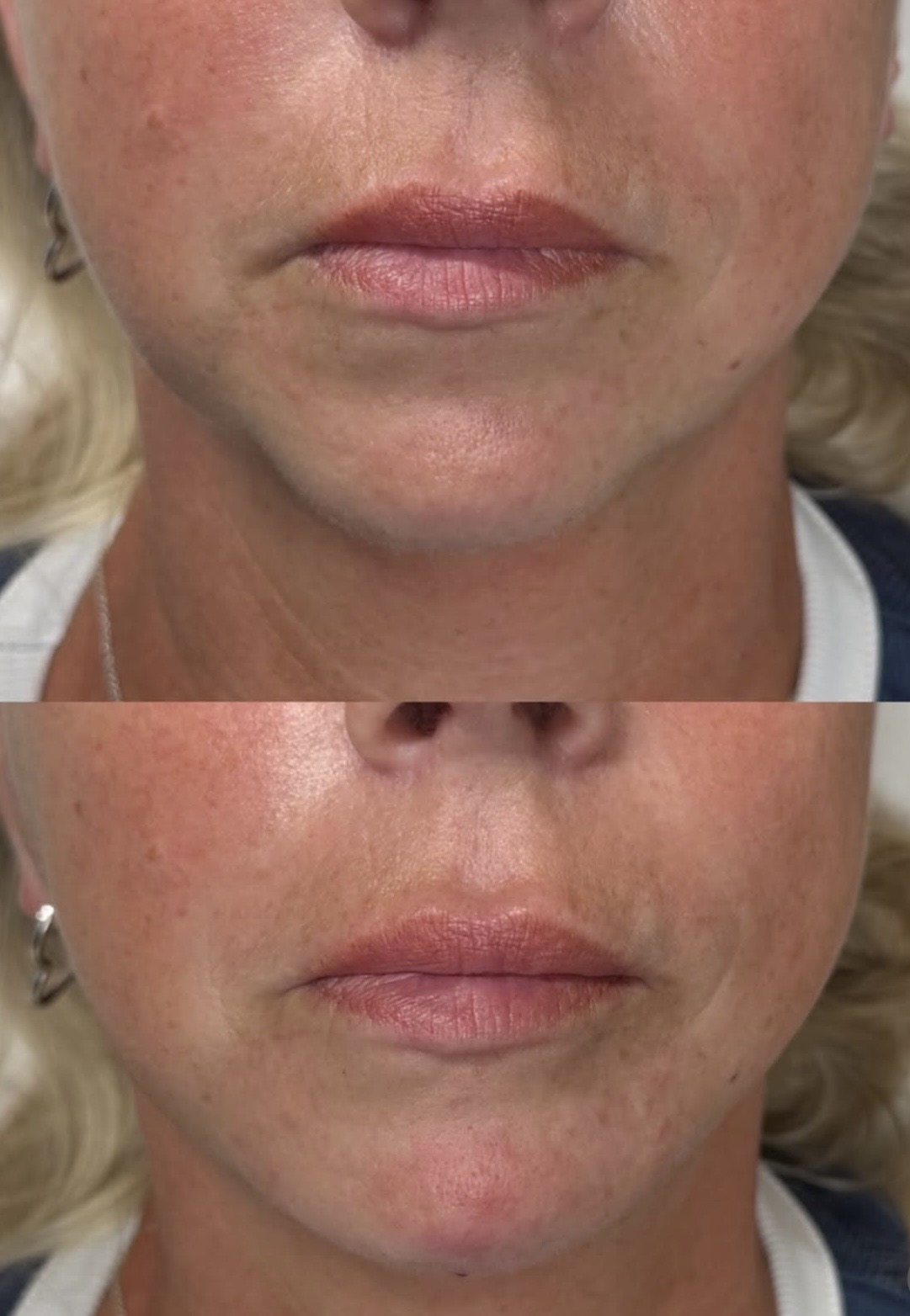 Jowl & Chin Transformation This result is a perfect example of why we don’t believe in overfilling.