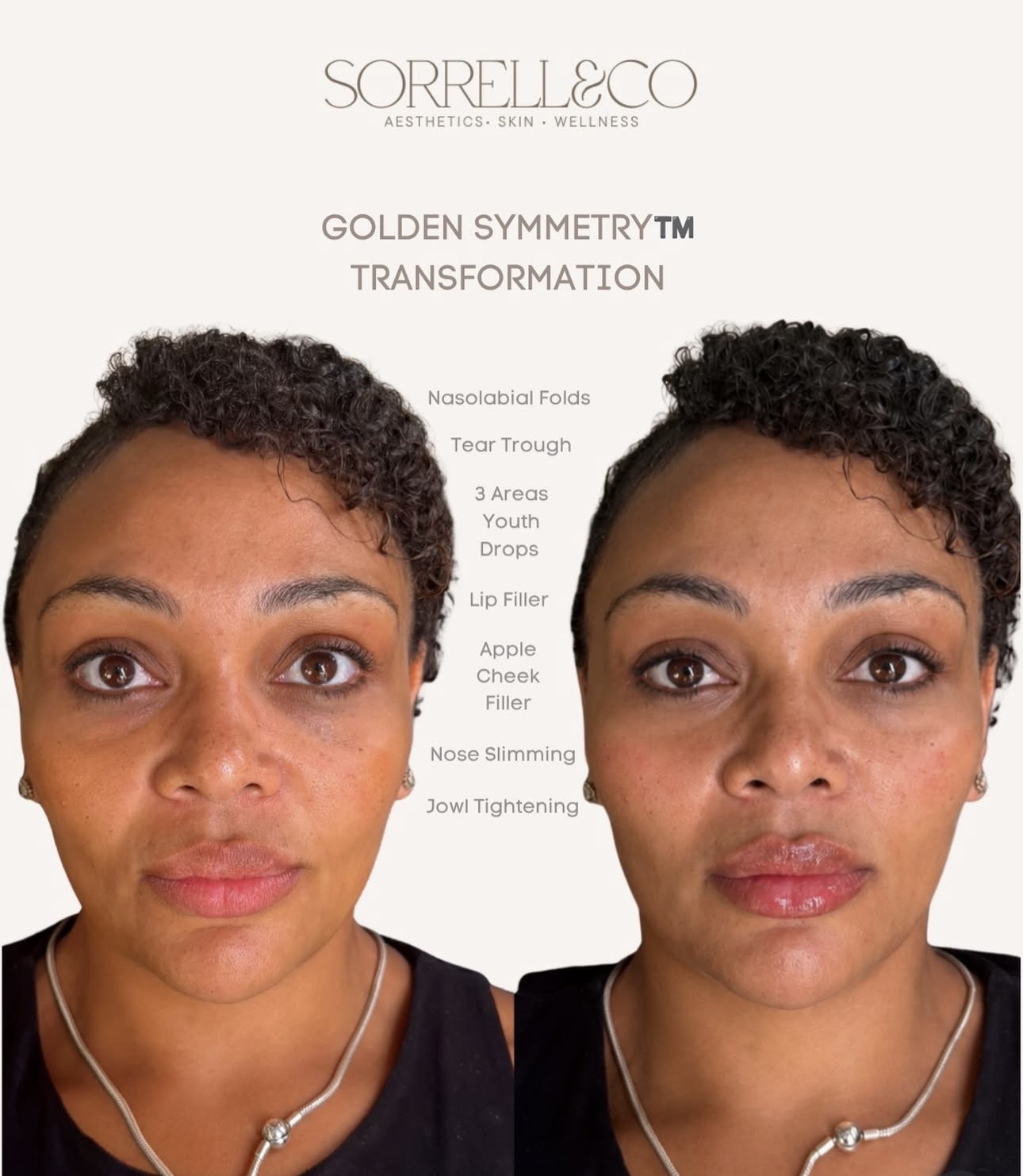 Your eyes probably went straight to the lips… 👀 …or maybe the tear troughs.