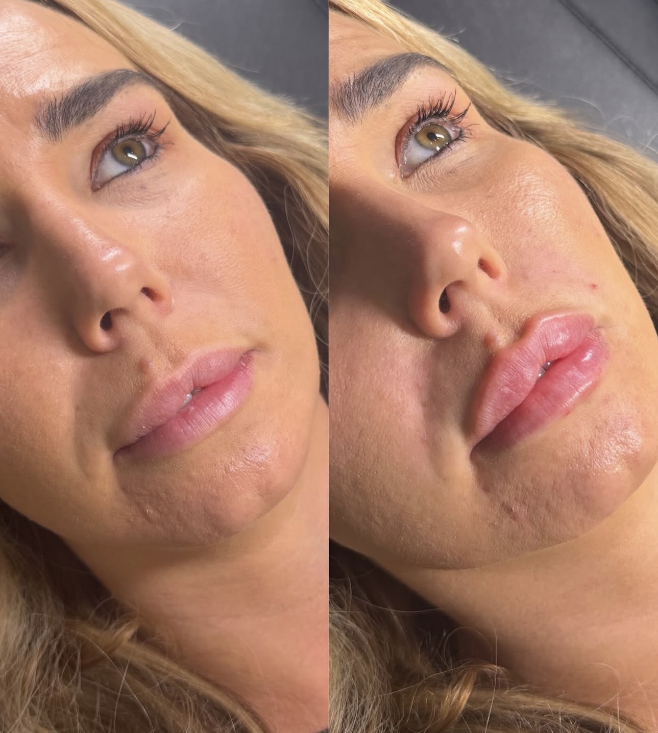Most people expect lip filler to completely change someone’s face.