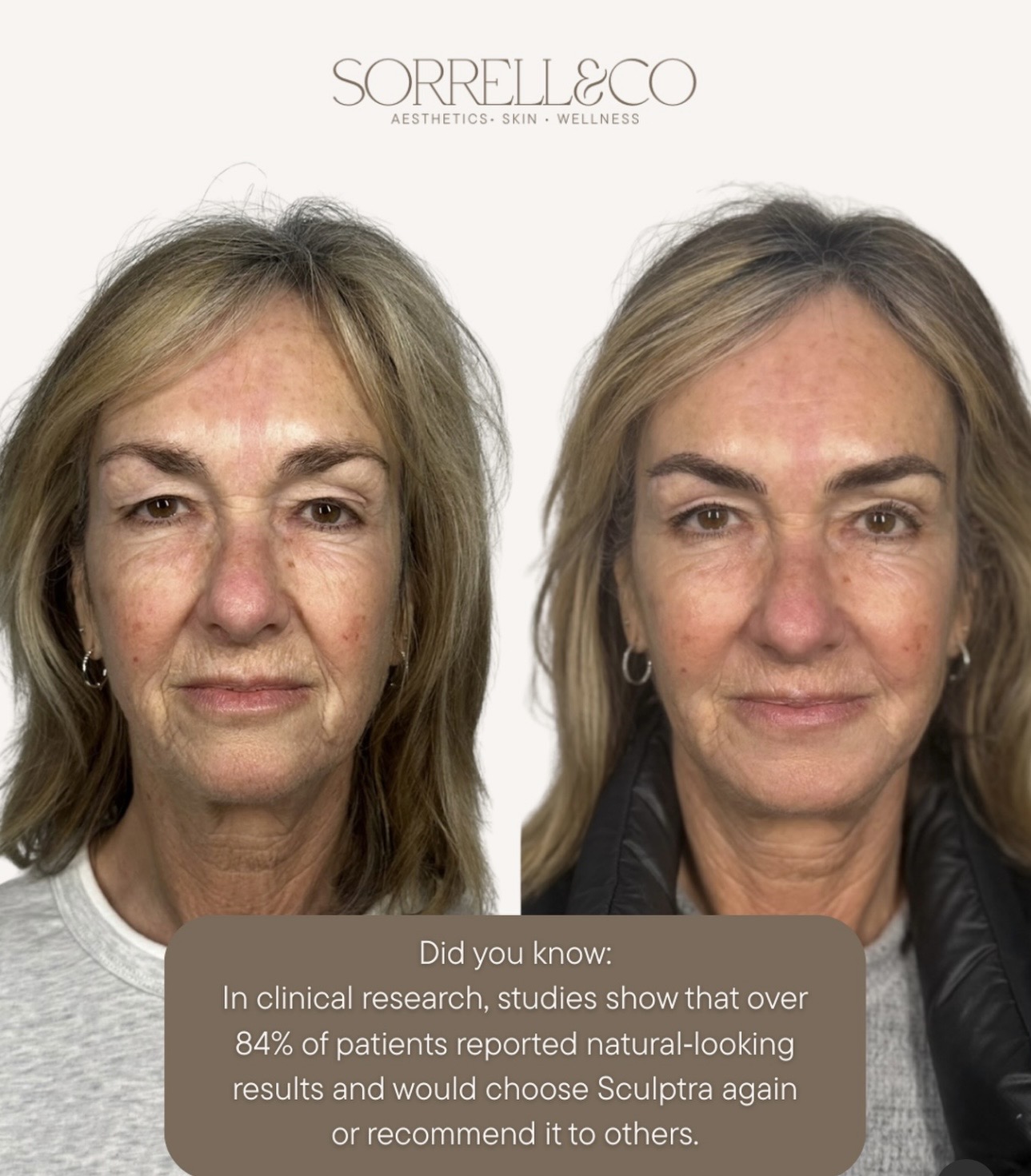 Our beautiful client Claire, who’s been on her Sculptra journey with us!