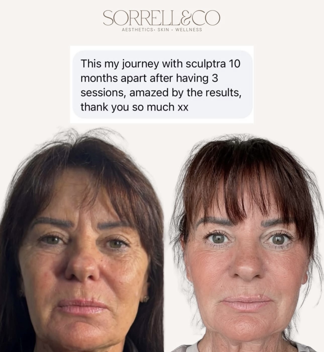 Results like these are exactly why we love collagen-stimulating treatments✨ This incredible transformation is 10 months af…