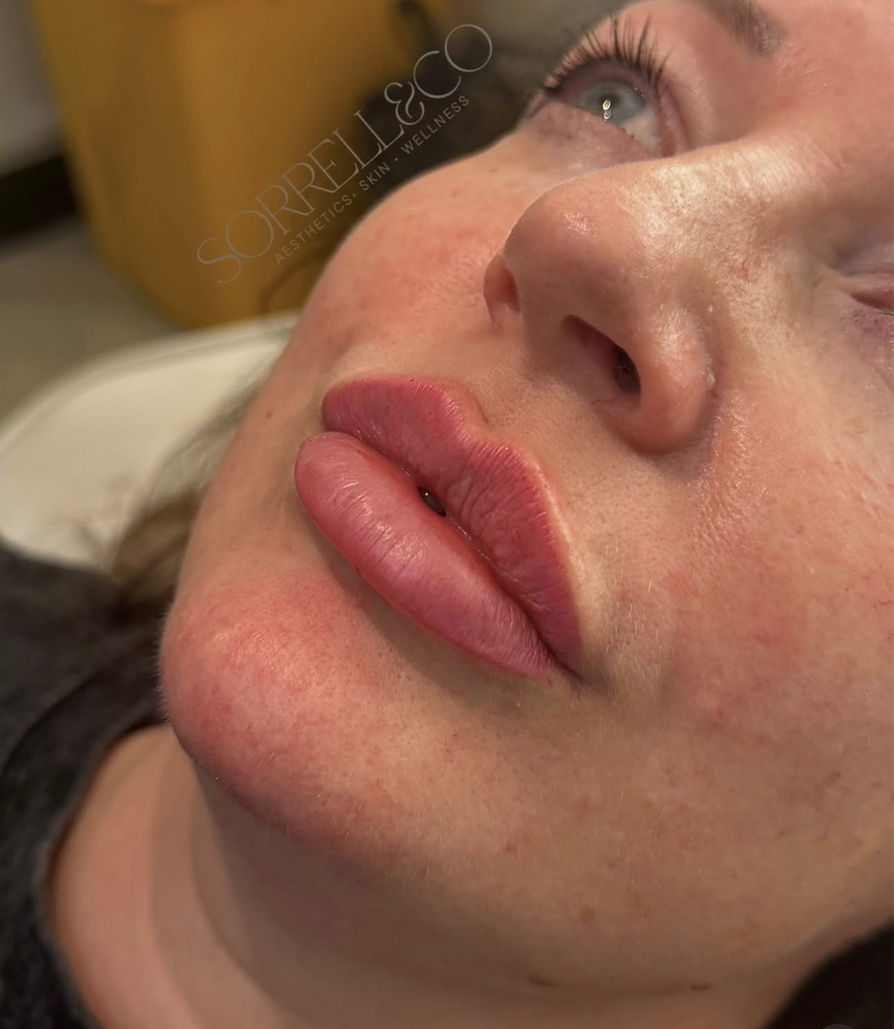 Russian Lips👄✨ Lip filler looks different on everyone because of our natural anatomy & shape which is why it’s one of our…