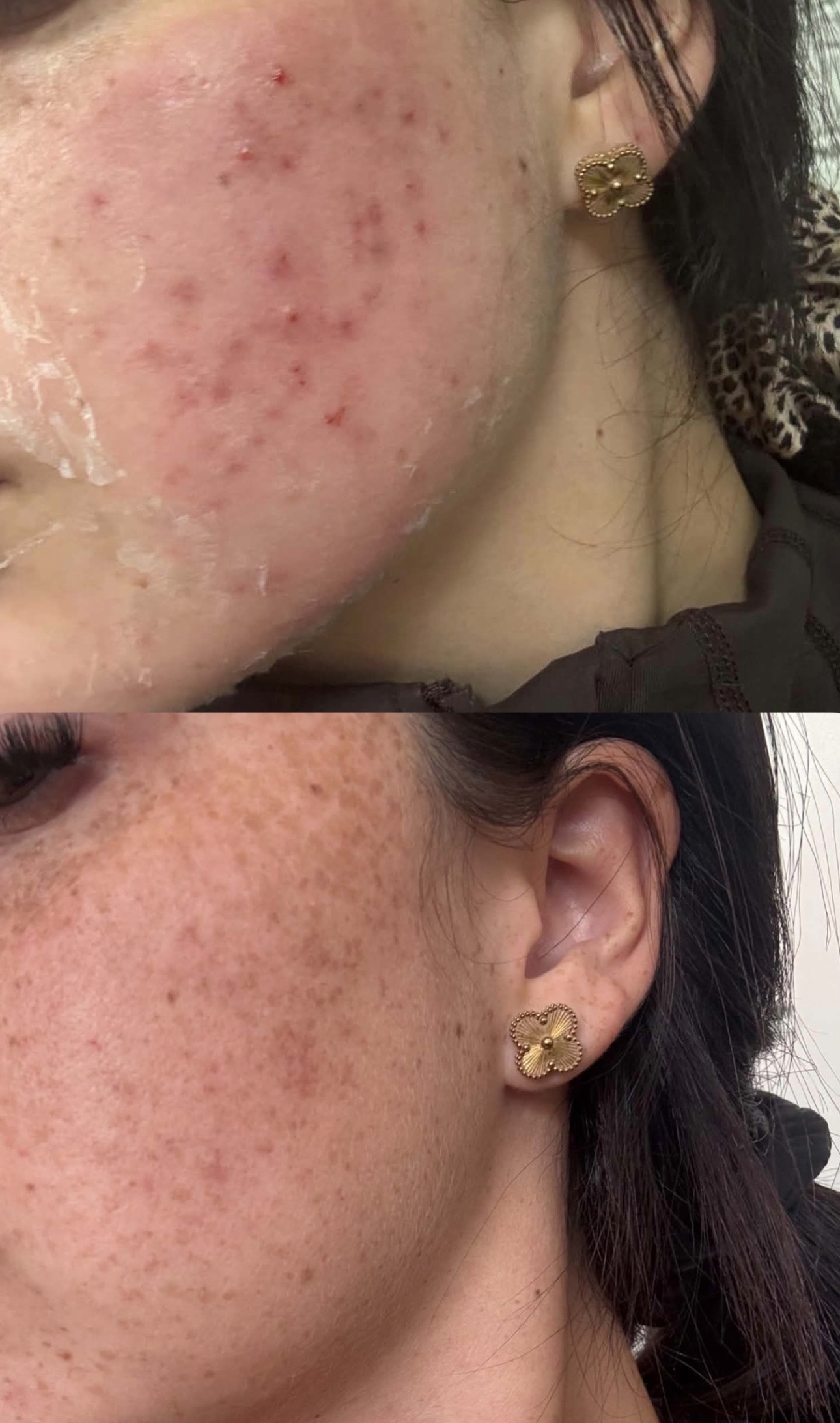 Acne- Do you suffer from acne?