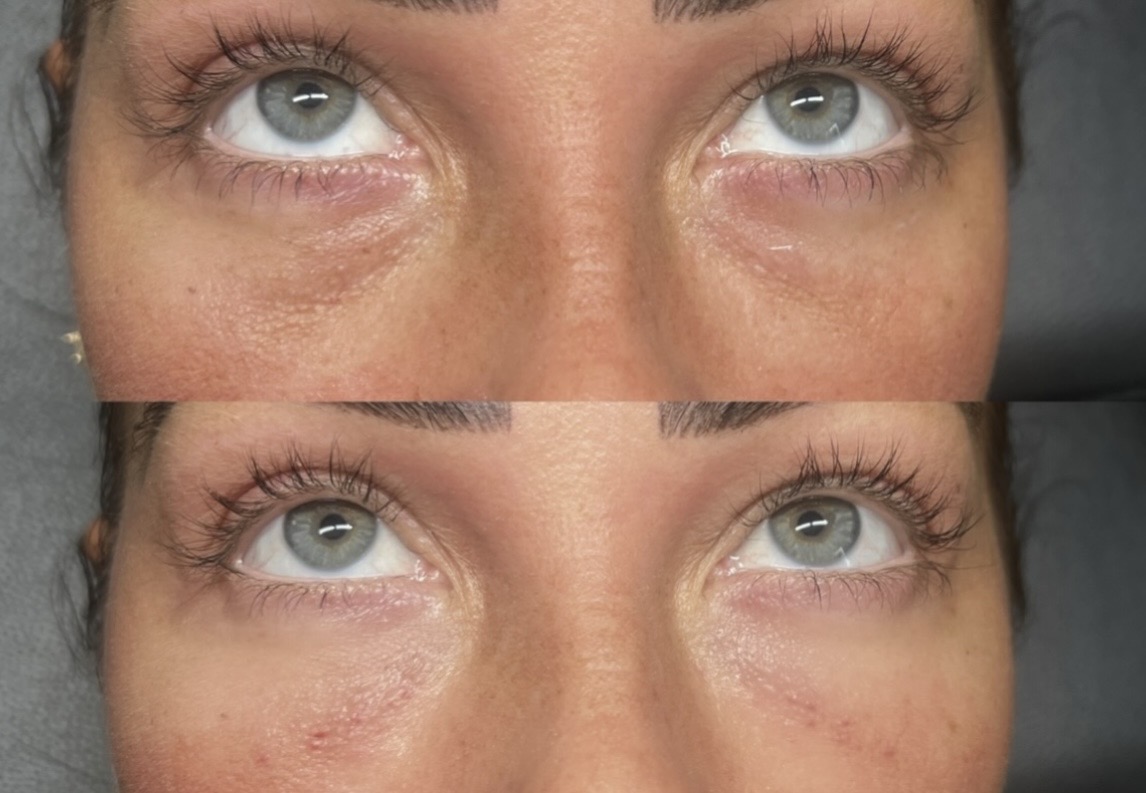 Tear Trough- If your under eyes appear sunken then our tear trough may be the perfect treatment for you.