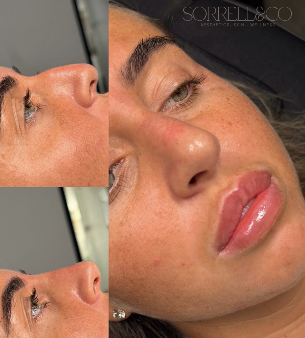 Non Surgical Rhinoplasty- Do you lack confidence because of the shape of your nose?