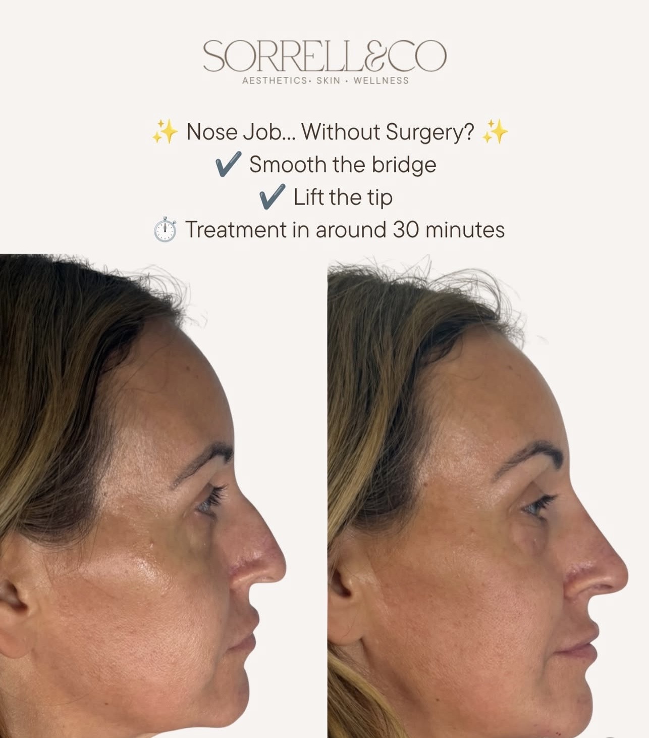 This is what a non-surgical rhinoplasty can achieve.