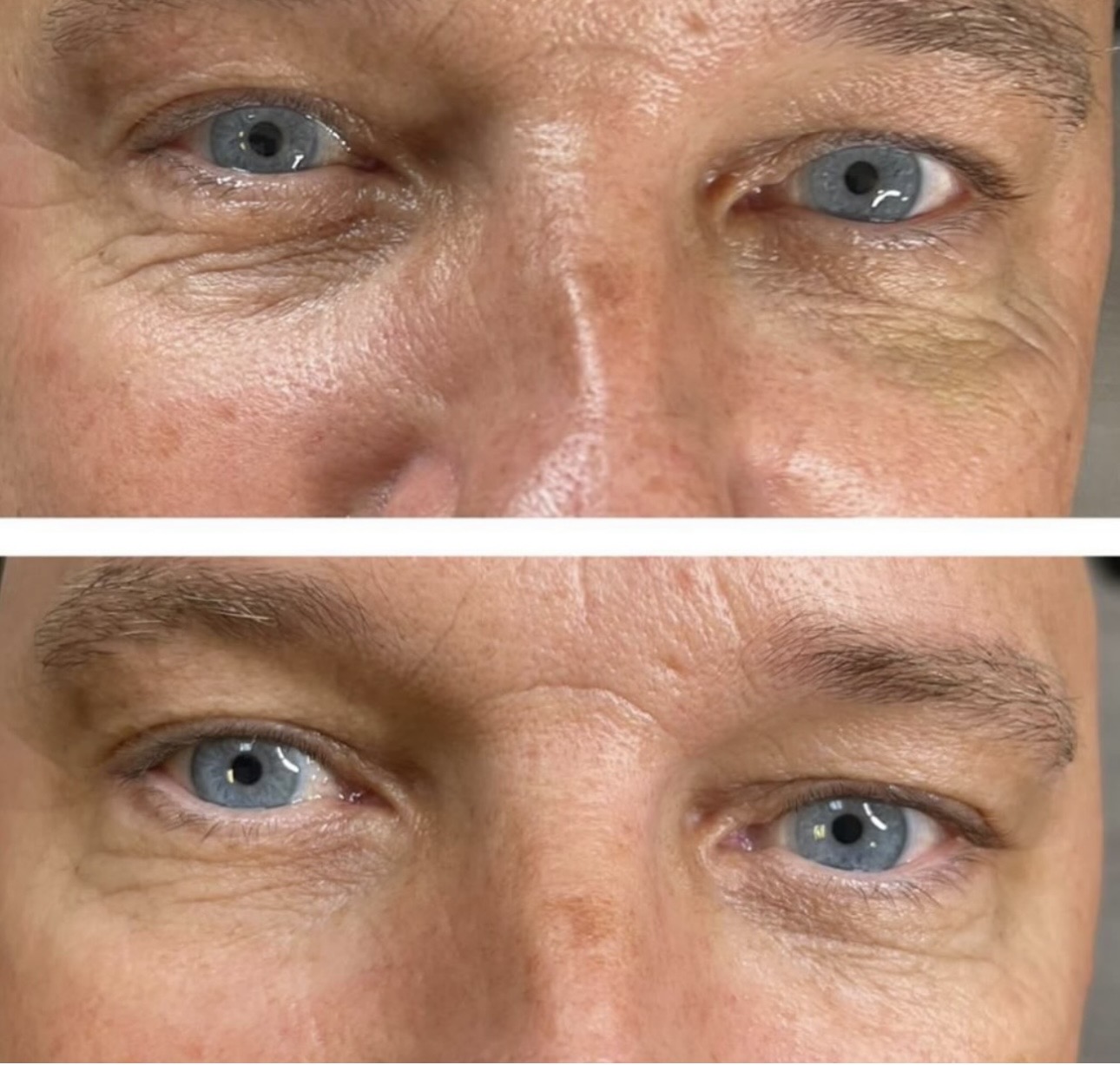 Polynucleotide & anti-wrinkle treatment- Our client had 3 sessions of Vitaran polynucleotide & crow's feet anti-wrinkle tr…