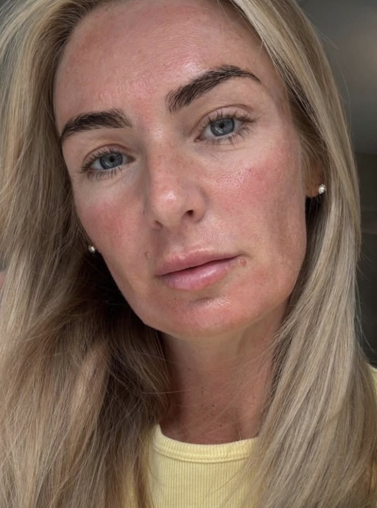 Our beautiful client Danielle who has monthly Microneedling & Chemical Peel treatments to keep her skin fresh and fine lin…