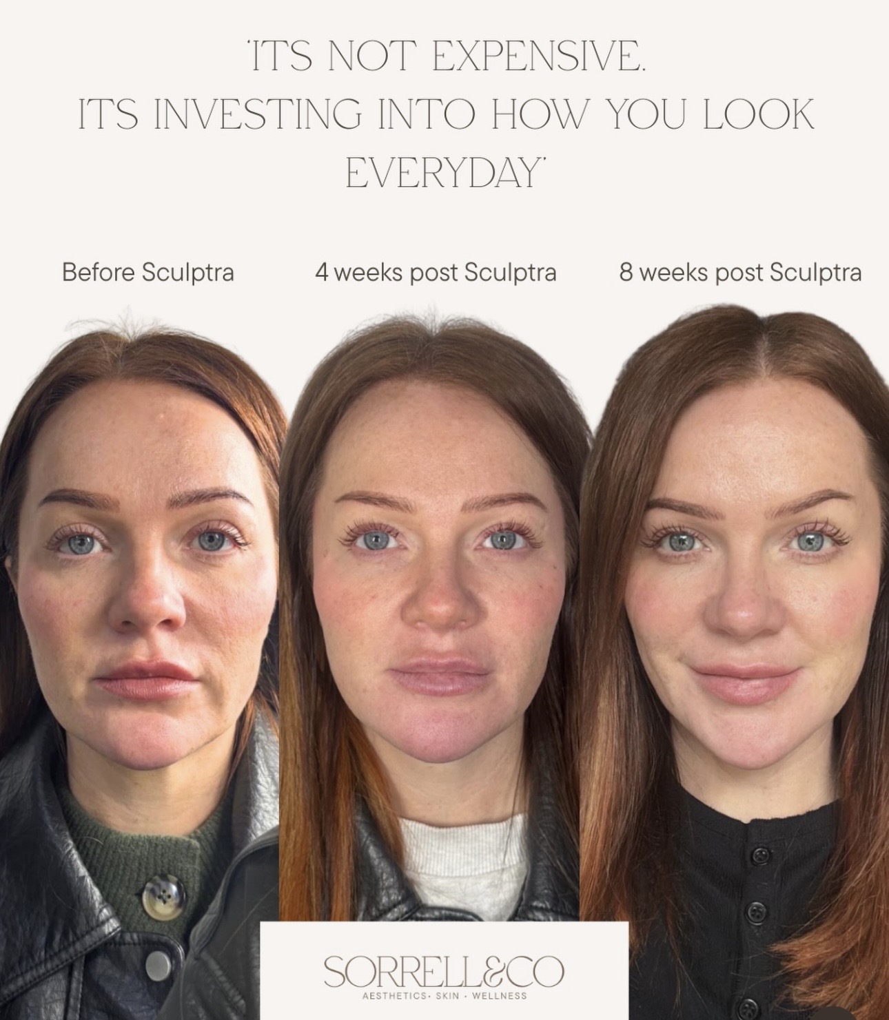 Sculptra & anti-wrinkle treatment- Rachel has been on her Sculptra with us over the past year, and look at the difference…