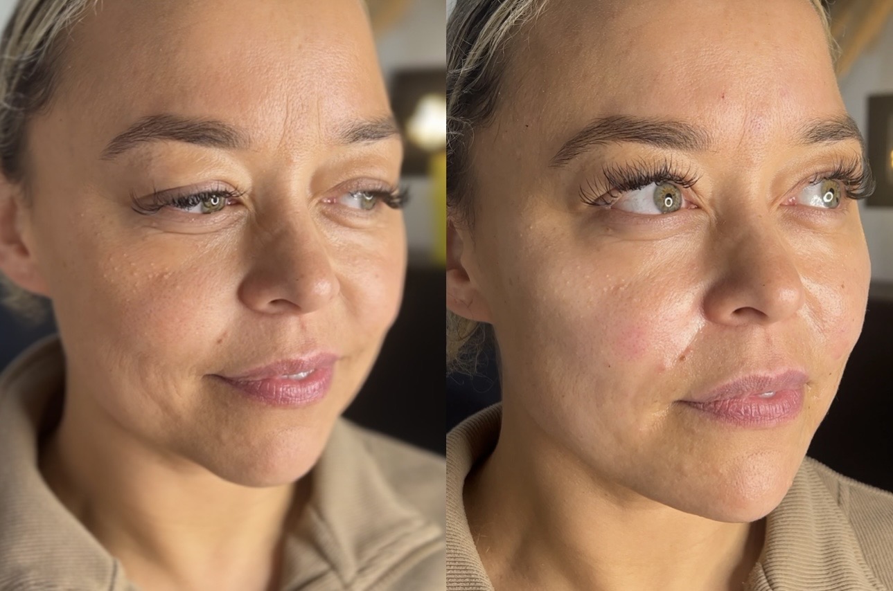 Hayley felt her lower face was looking old so we added dermal filler into her jowls, 1ml of chin filler to contour her low…