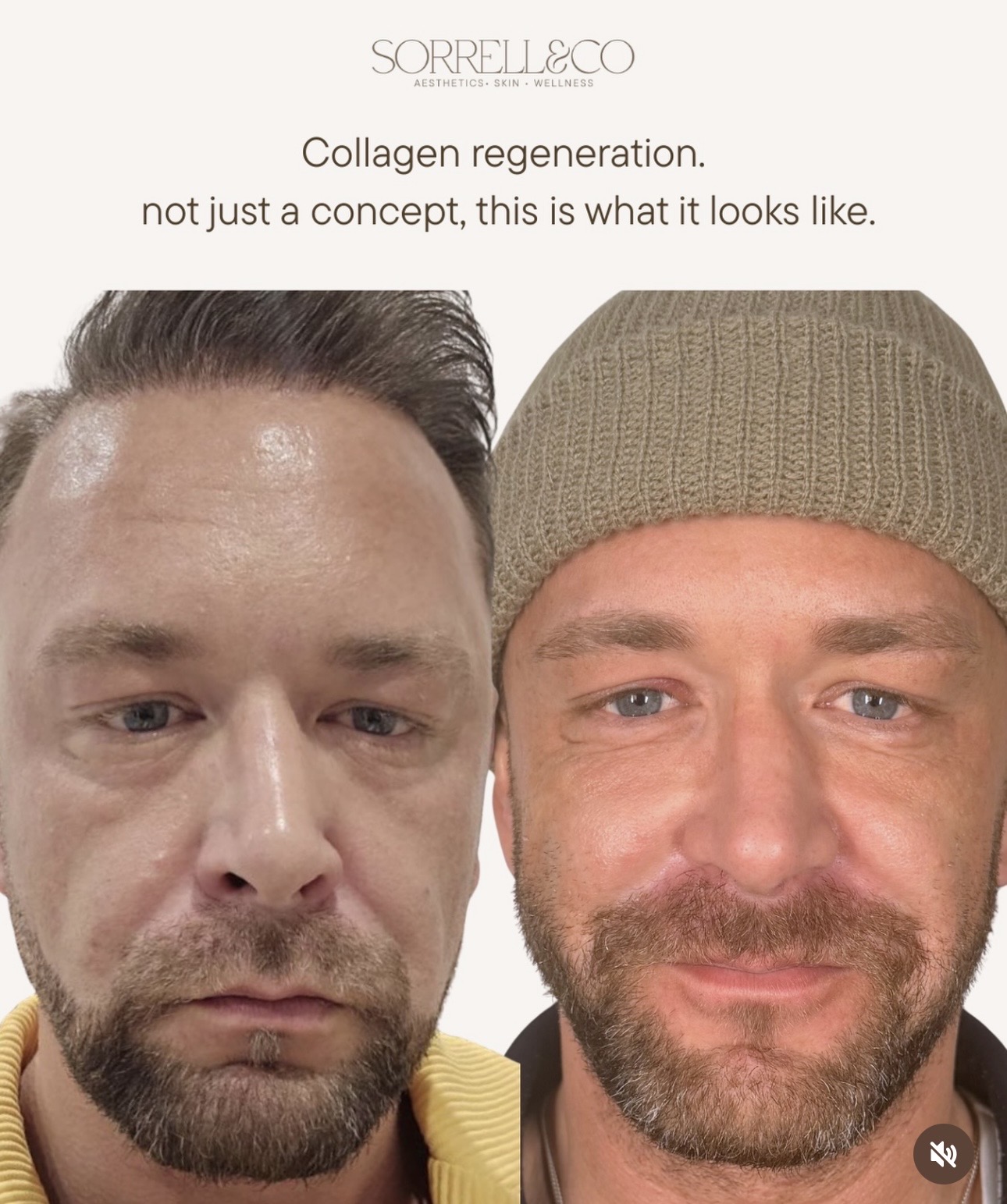 Men’s Treatments- Dan has been coming to Sorrell for around a year now, and he regularly has anti-wrinkle treatment, Sculp…